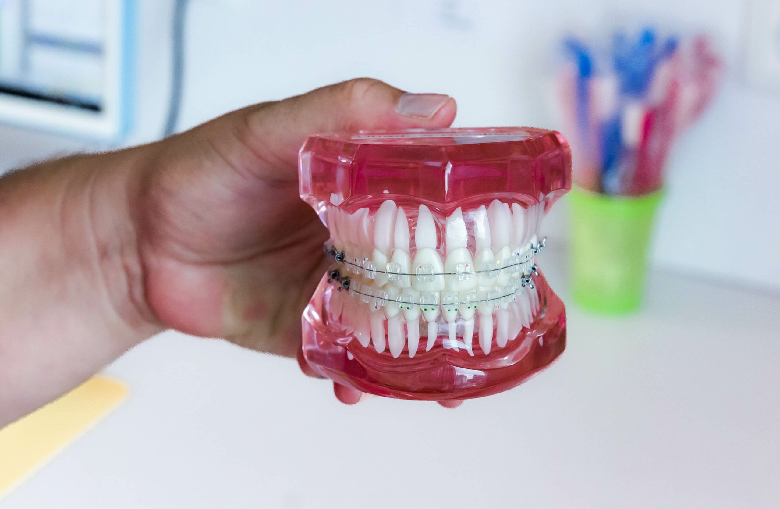 Glaskeramik Brackets